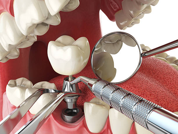 Best Emergency Treatment for Dental Infections or Abscesses in Upper Arlington, OH